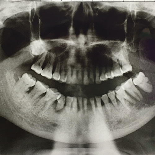 X-ray of Oral Cancer